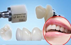 Trung tâm nha khoa Nguyễn Trãi Trám răng thẩm mỹ